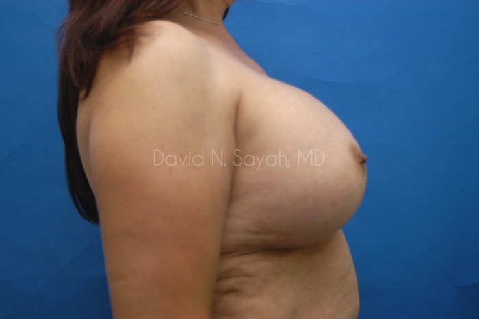 Breast Augmentation Before and After | Sayah Institute