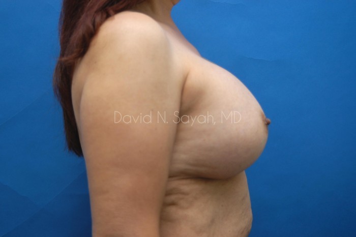 Breast Augmentation Before and After | Sayah Institute