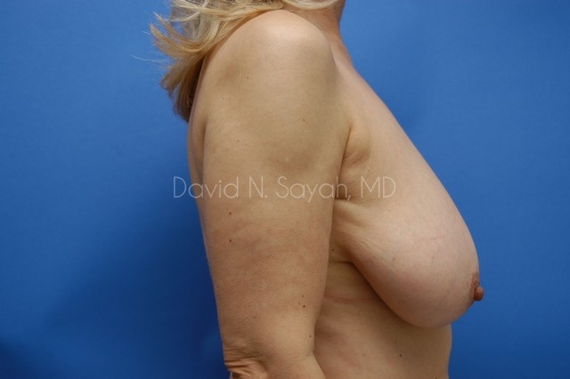 Breast Lift Before and After | Sayah Institute