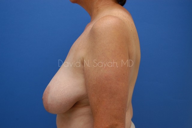 Breast Reduction Before and After | Sayah Institute