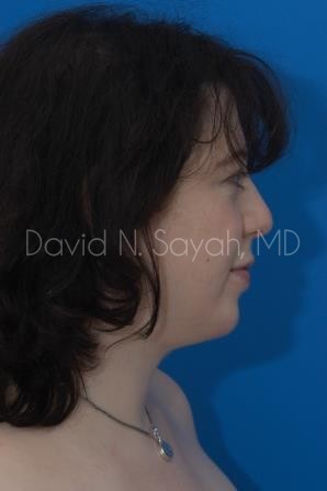 Chin Implant Before and After | Sayah Institute