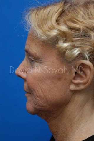 Co2 Laser Before and After | Sayah Institute