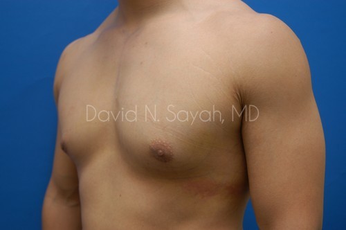 Liposuction Before and After | Sayah Institute