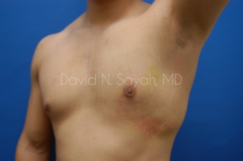 Male Breast Surgery Before and After | Sayah Institute