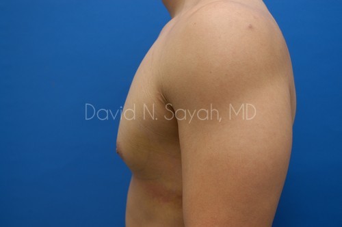Male Breast Surgery Before and After | Sayah Institute
