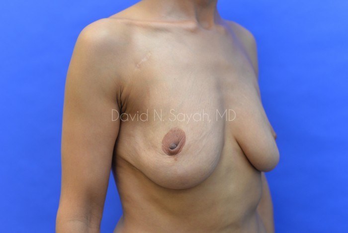 Nipple Revision Before and After | Sayah Institute