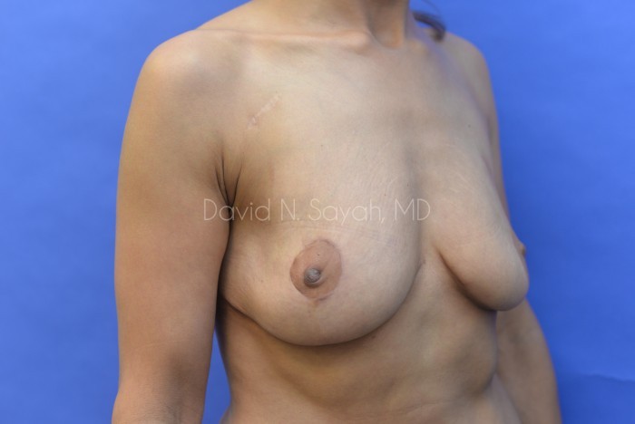 Nipple Revision Before and After | Sayah Institute
