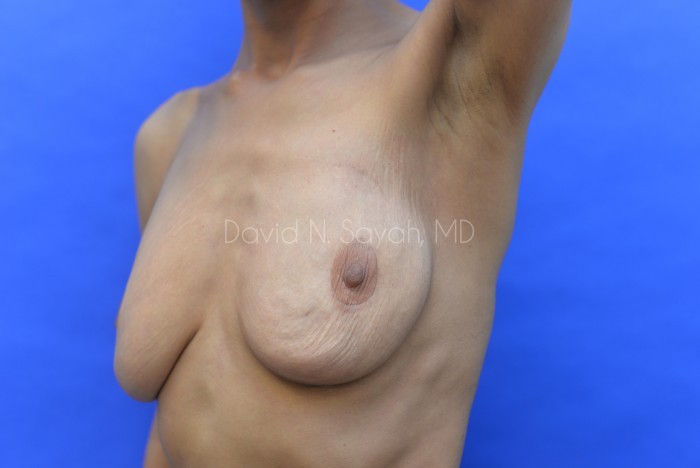 Nipple Revision Before and After | Sayah Institute