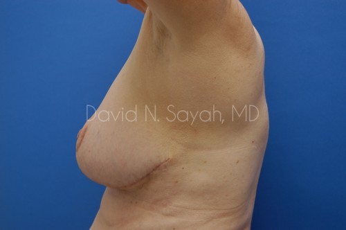 Nipple Revision Before and After | Sayah Institute