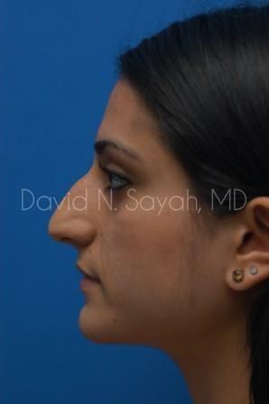 Rhinoplasty Before and After | Sayah Institute