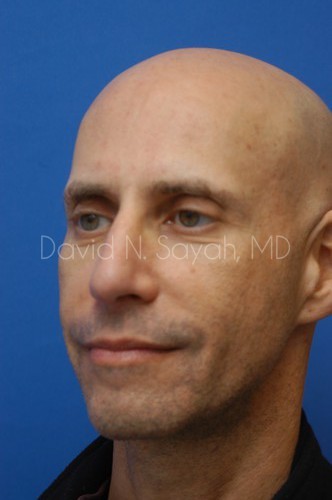 Rhinoplasty Before and After | Sayah Institute