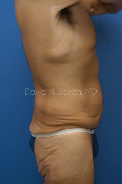 Tummy Tuck Before and After | Sayah Institute