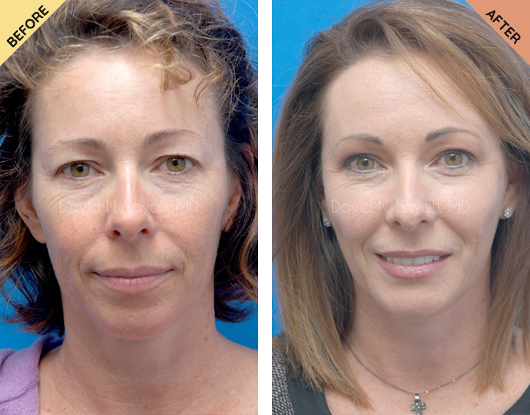 A before and after picture of a woman 's face.