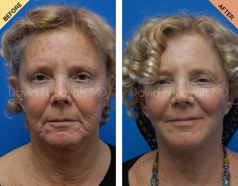 A before and after picture of an older woman 's face.