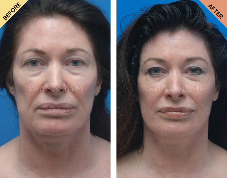 A woman with a facelift before and after surgery.