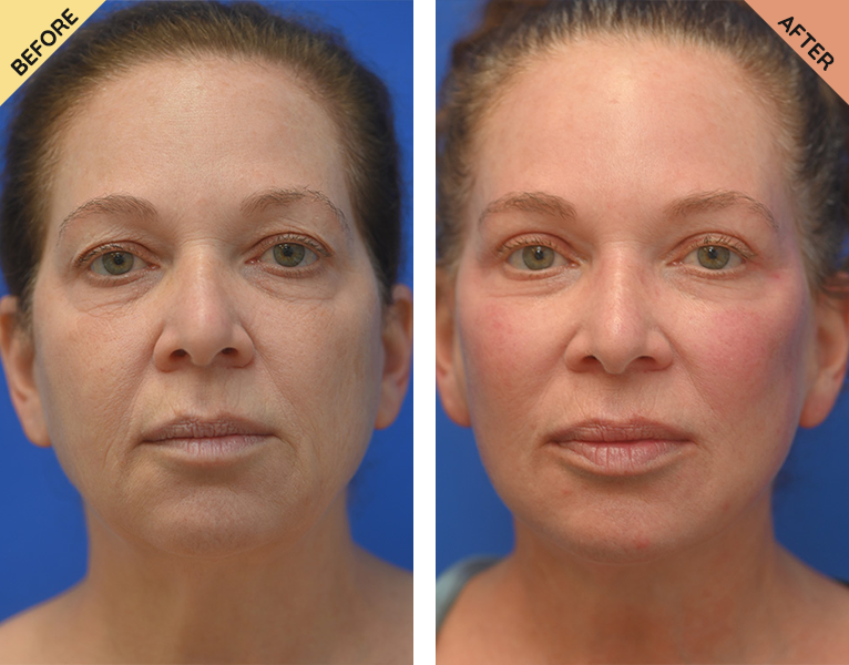 A woman with a facelift and chin implant