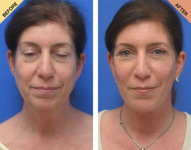 A woman with a facelift and chin implant