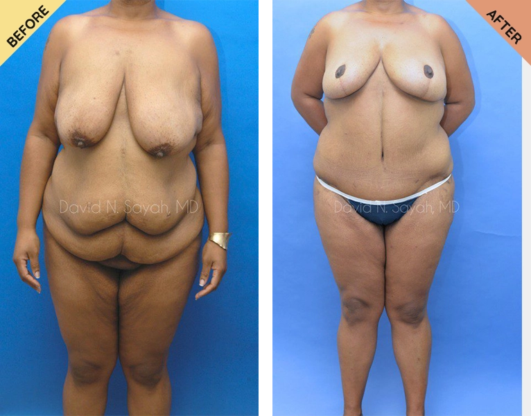 A woman before and after surgery to remove her breasts.