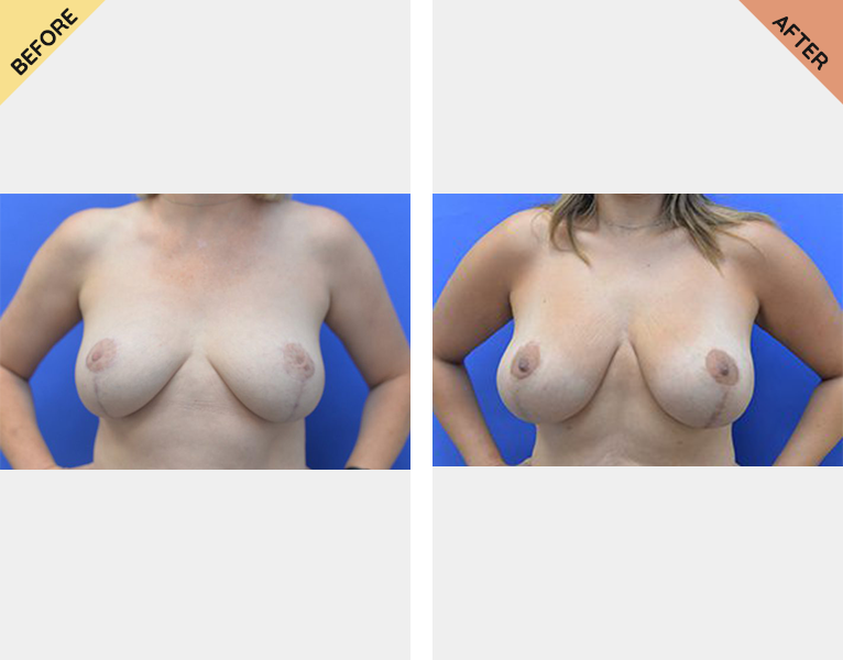 A before and after picture of breast reduction surgery.