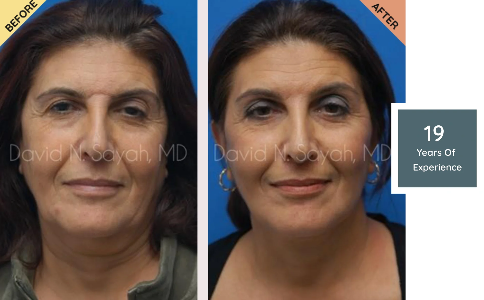 Before and after images of a woman showing cosmetic changes to her face, labeled with "19 Years of Experience.